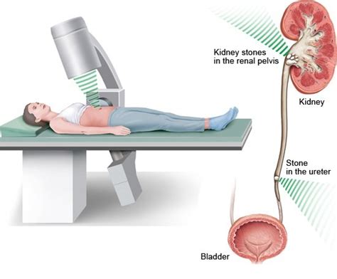 kidney stone vibration treatment|after shockwave kidney stone treatment.